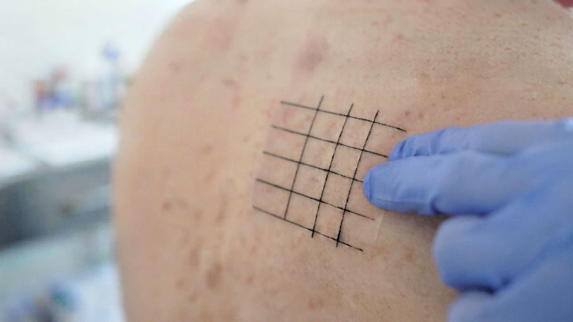 Contact Allergy & Patch Test Procedure