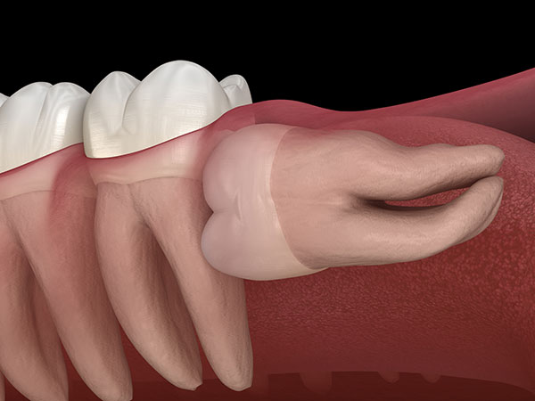 Oral1