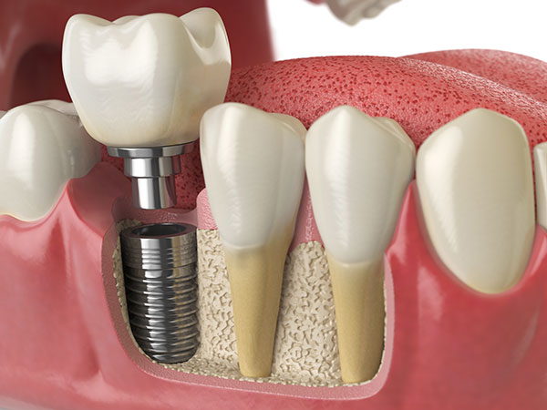 Oral3